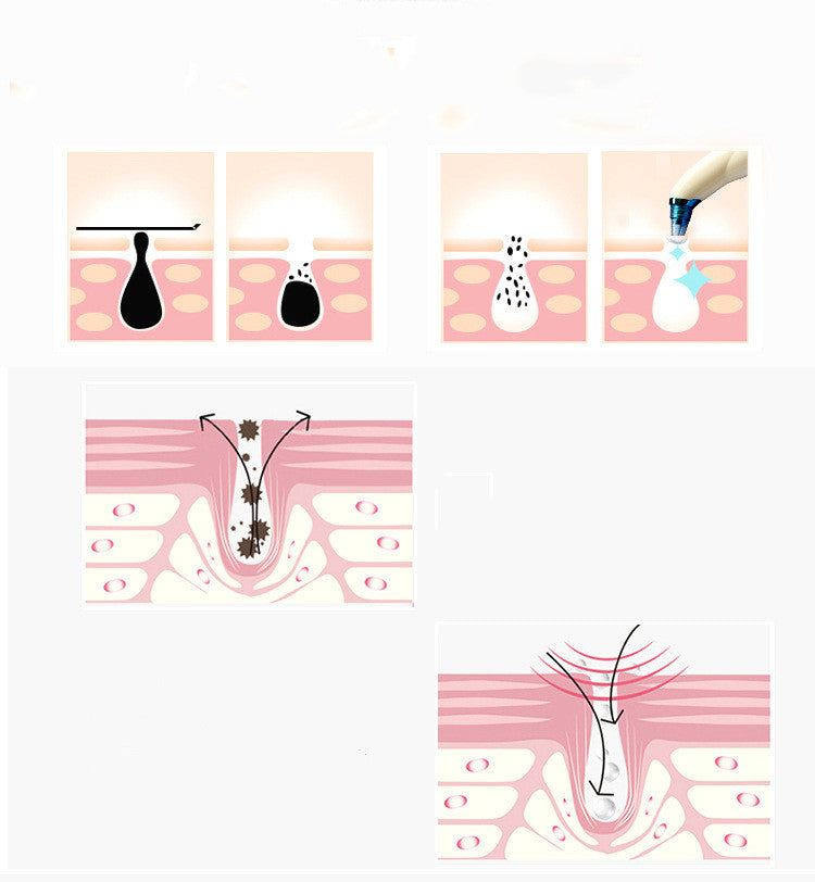 Blackhead Remover Vacuum | Electric Blackheads Remover | This N That