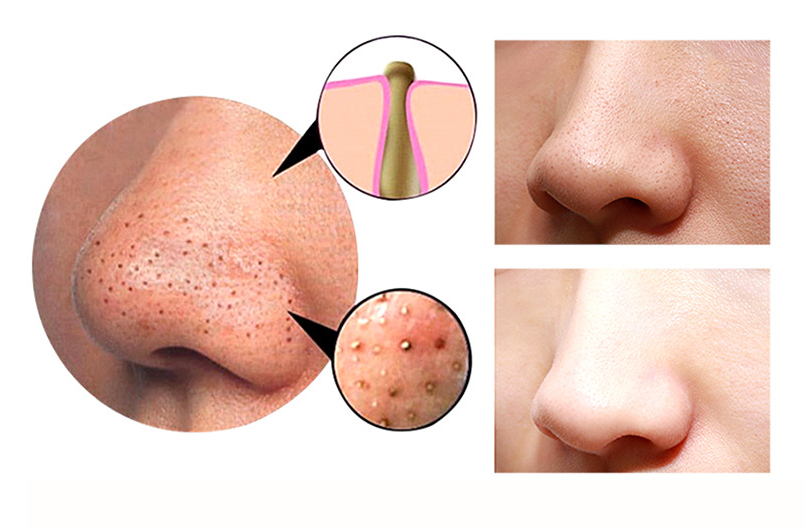 Blackhead Remover Machine | Pore Cleaning Device | This N That